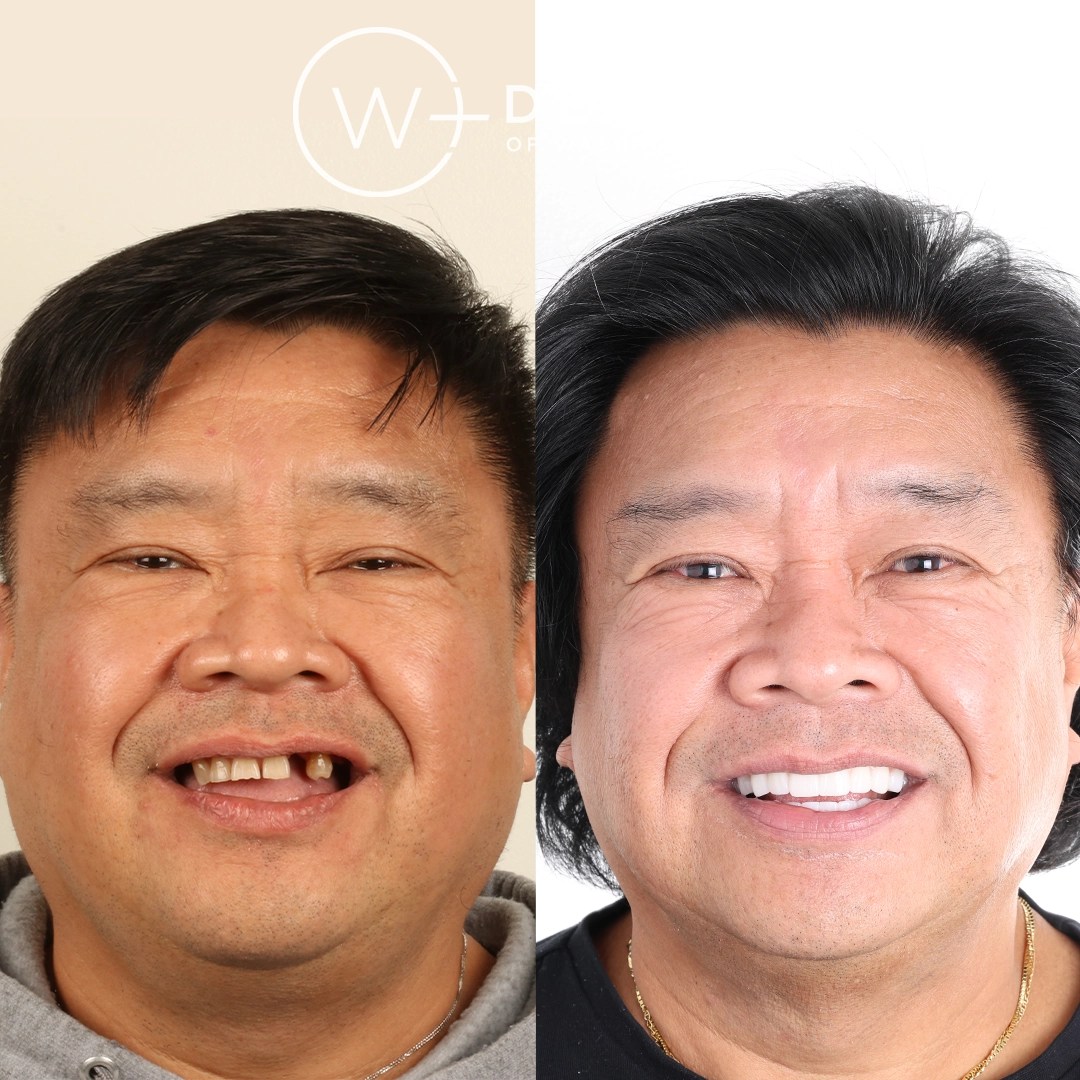 before and after dental bonding for a chipped tooth