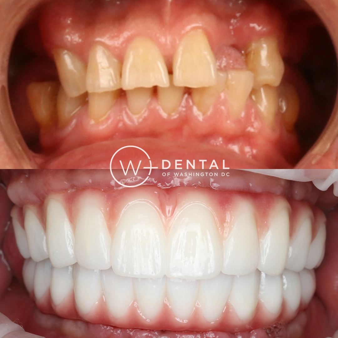 before and after dental bonding for a chipped tooth