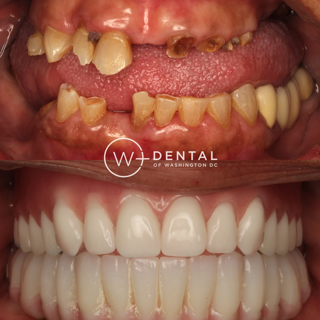 before and after dental bonding for a chipped tooth