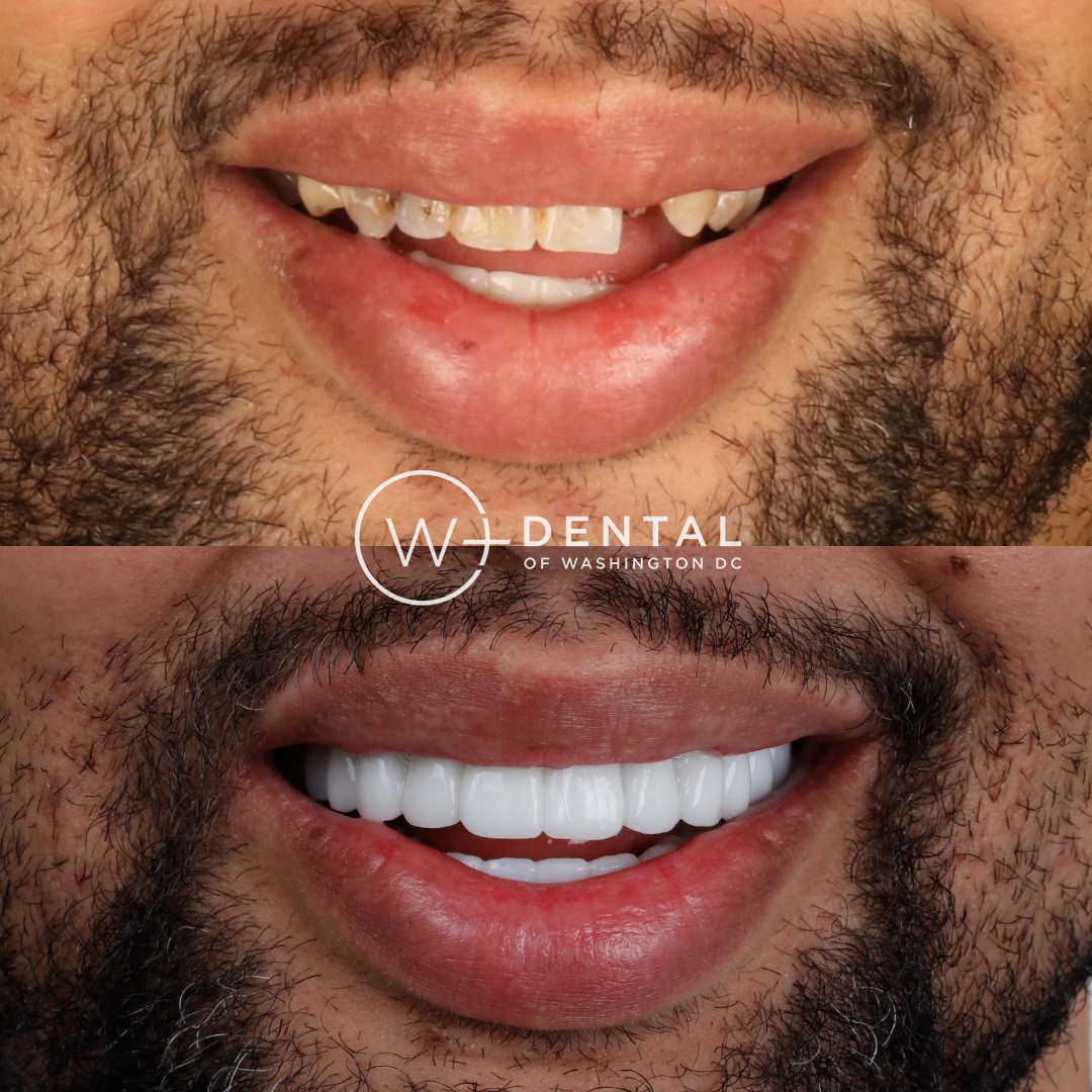 before and after dental bonding for a chipped tooth