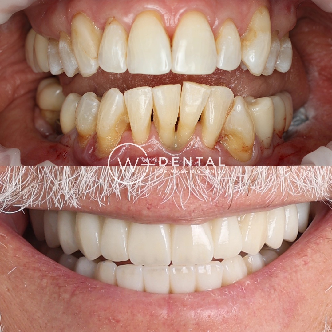 before and after dental bonding for a chipped tooth