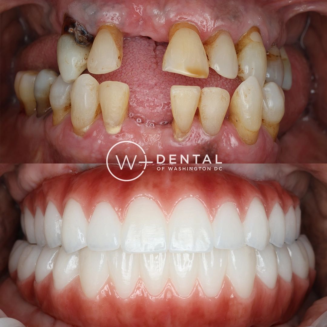 before and after dental bonding for a chipped tooth