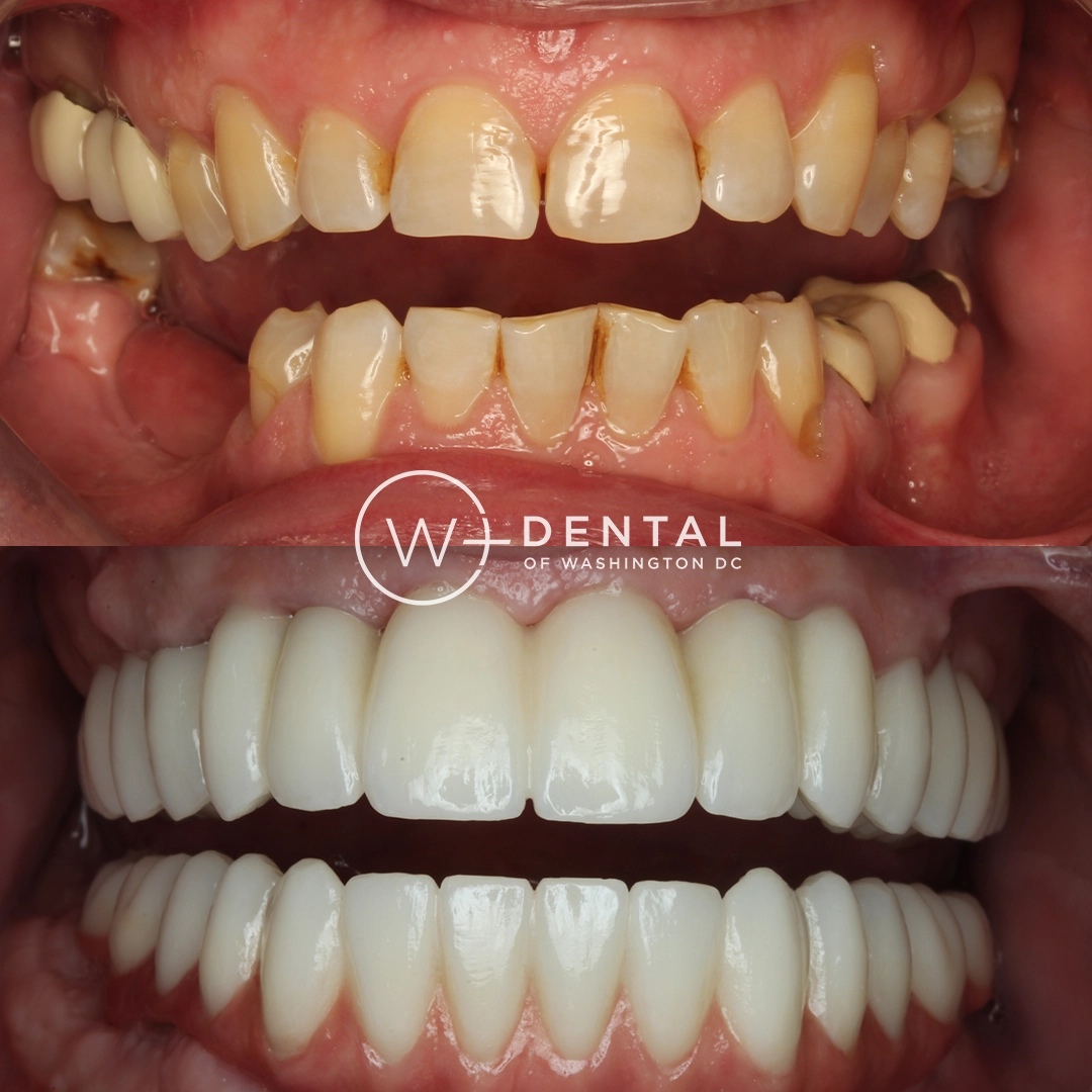 before and after dental bonding for a chipped tooth