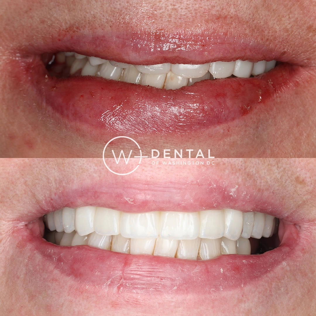 before and after dental bonding for a chipped tooth