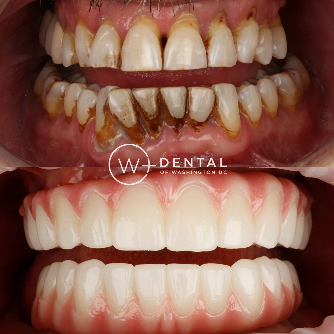 before and after dental bonding for a chipped tooth