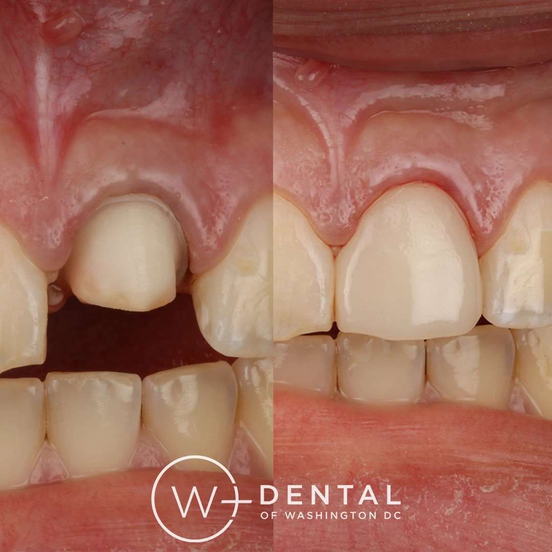 before and after dental bonding for a chipped tooth