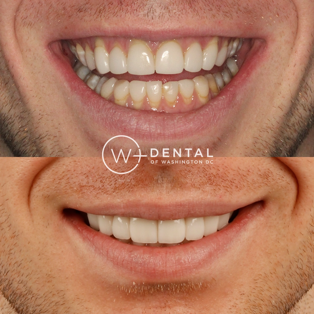 before and after dental bonding for a chipped tooth