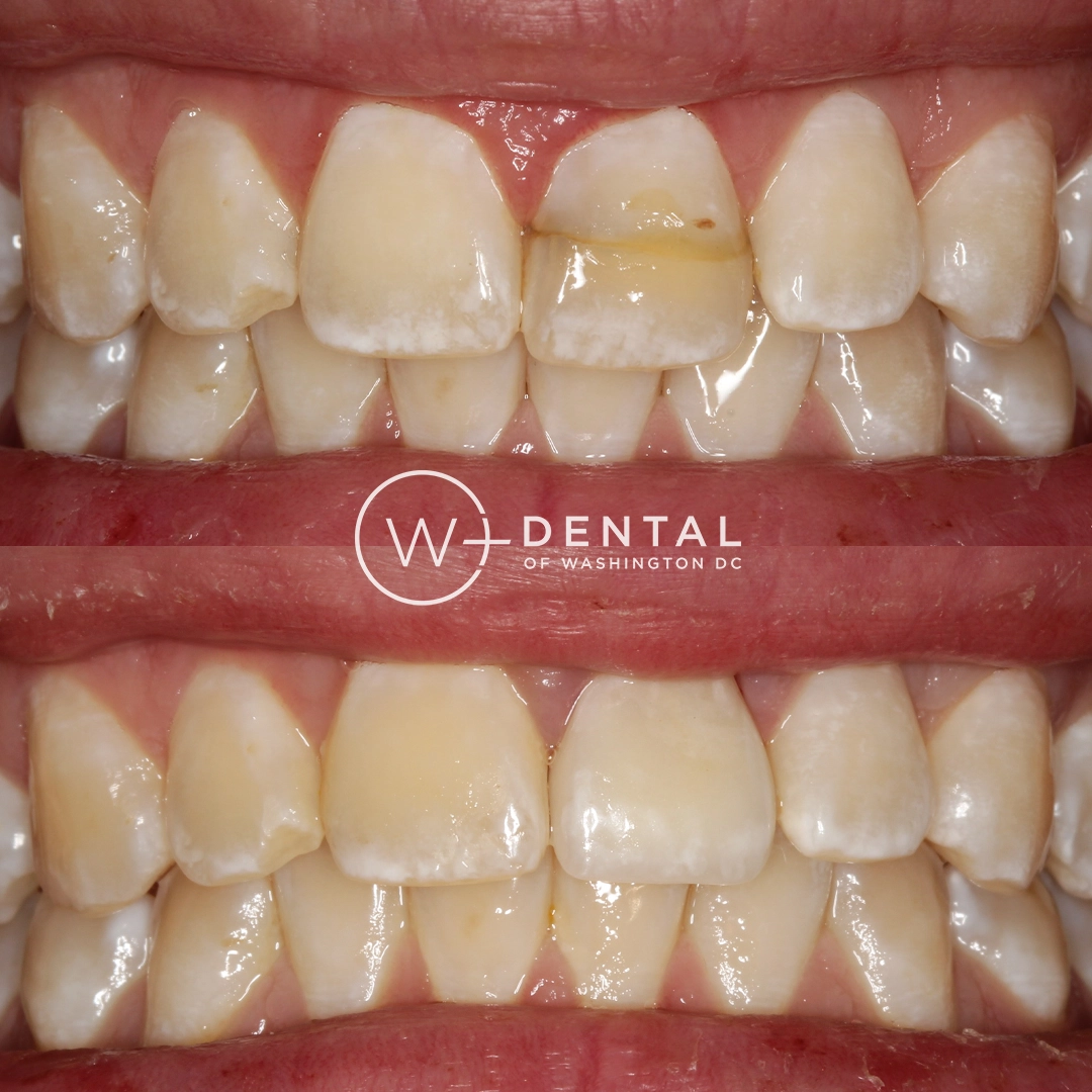 before and after dental bonding for a chipped tooth