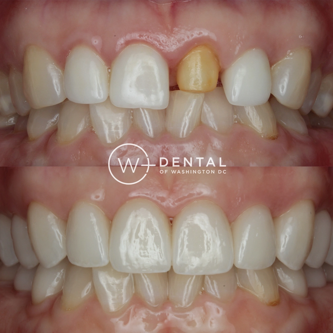 before and after dental bonding for a chipped tooth