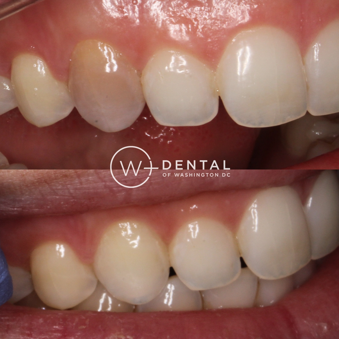 before and after dental bonding for a chipped tooth