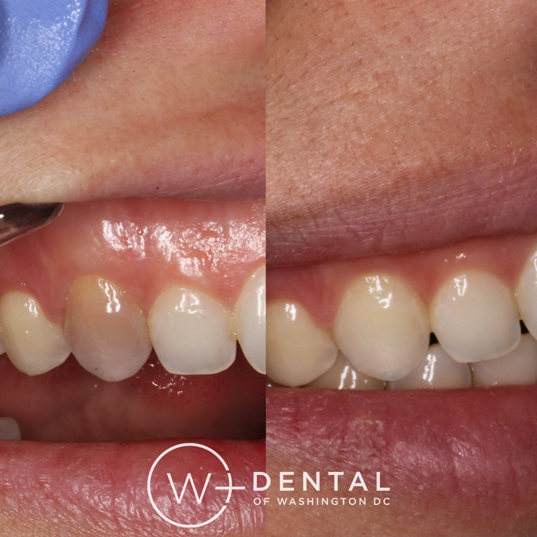 before and after dental bonding for a chipped tooth