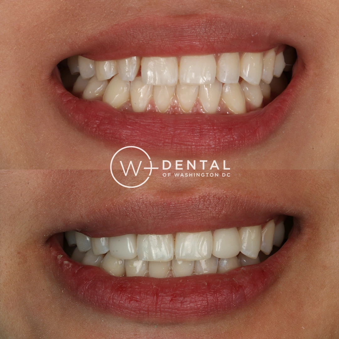 before and after dental bonding for a chipped tooth