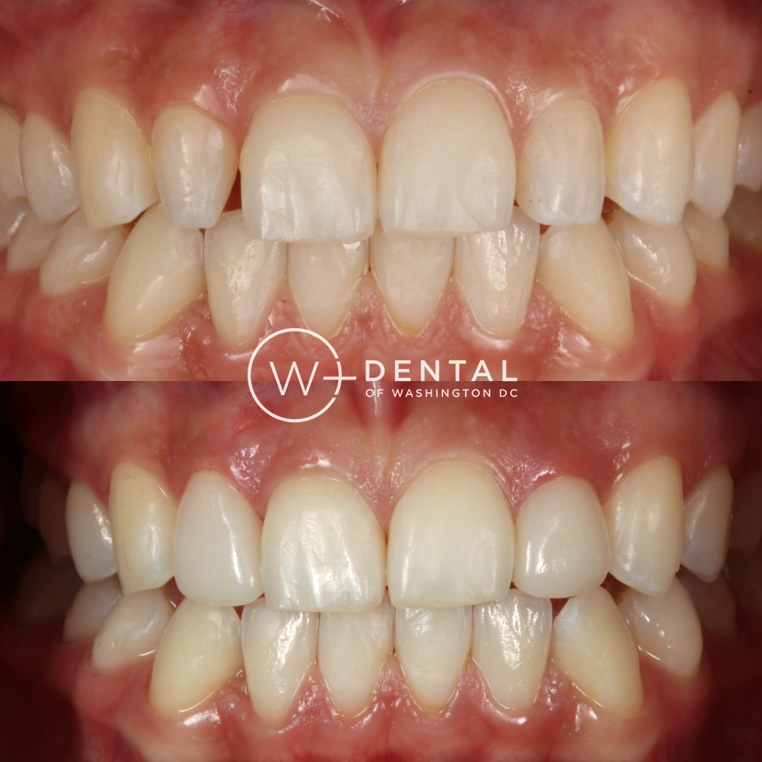 before and after dental bonding for a chipped tooth
