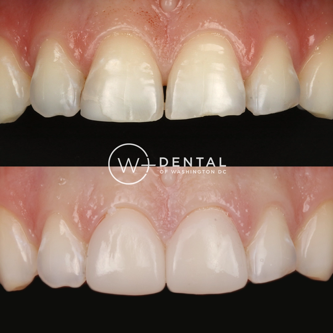 before and after dental bonding for a chipped tooth