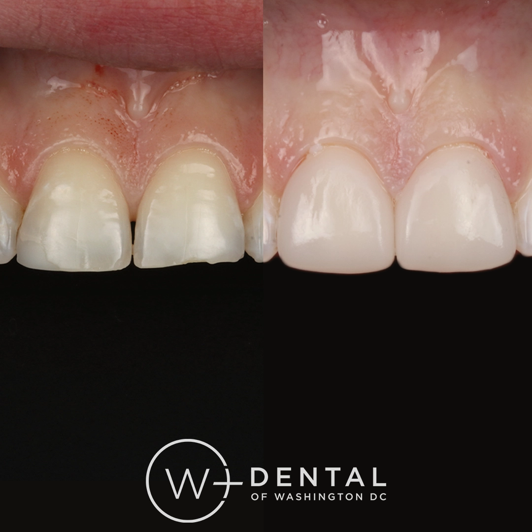 before and after dental bonding for a chipped tooth
