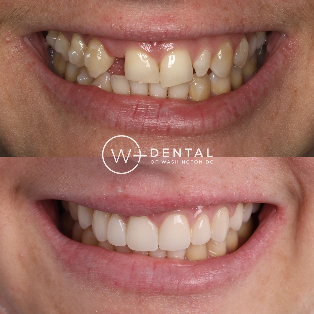 Before and after smile makeover with porcelain veneers and a dental bridge at W Plus Dental – full smile transformation correcting gaps, discoloration, and uneven teeth, Washington DC