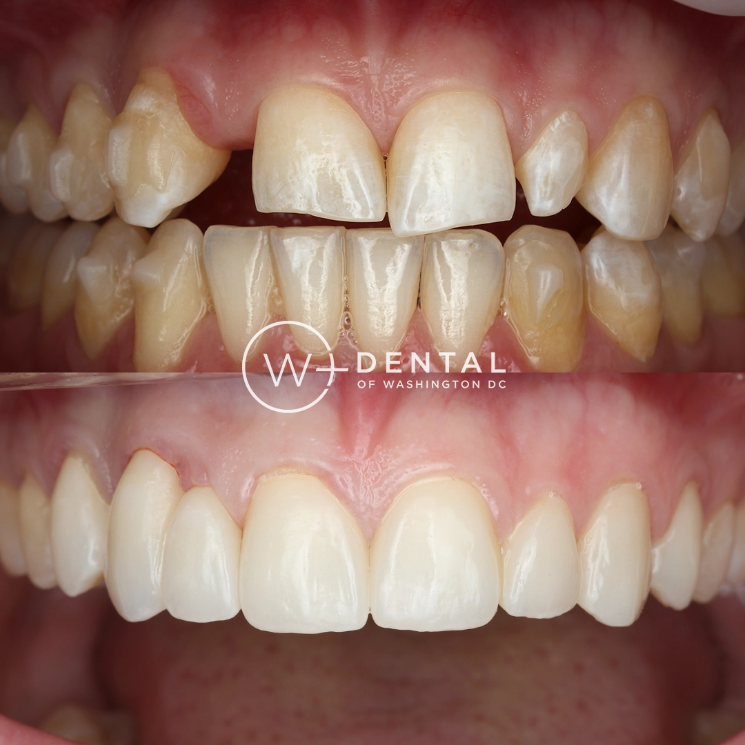 before and after dental bonding for a chipped tooth