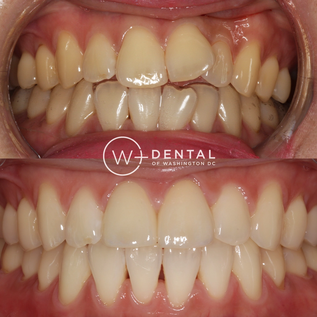 Before and after smile makeover with Invisalign and porcelain veneers at W Plus Dental – full smile transformation correcting gaps, discoloration, and uneven teeth, Washington DC