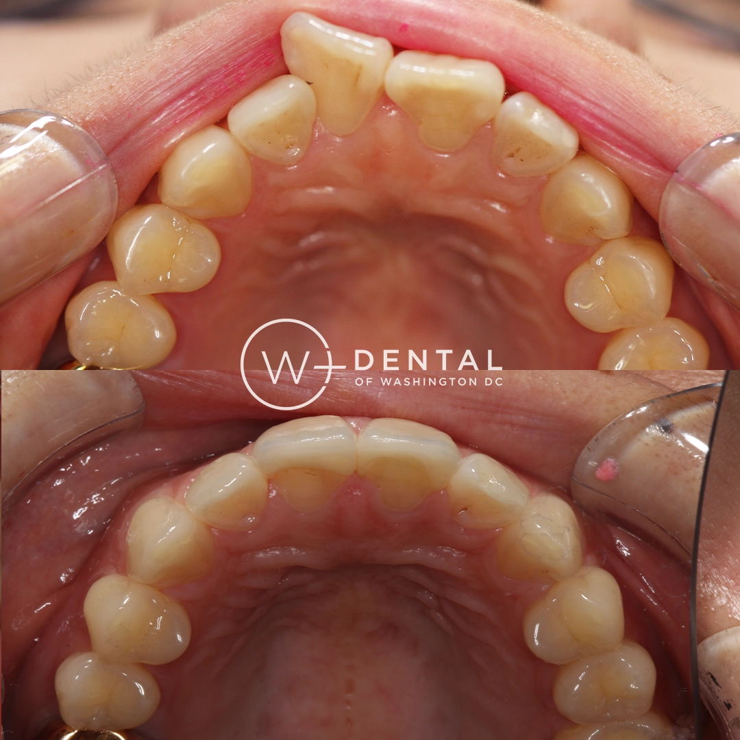 before and after dental bonding for a chipped tooth