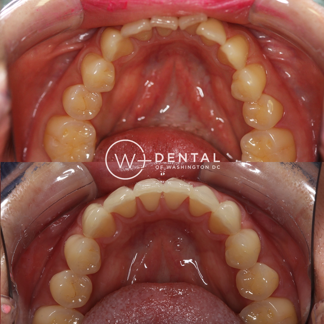 before and after dental bonding for a chipped tooth