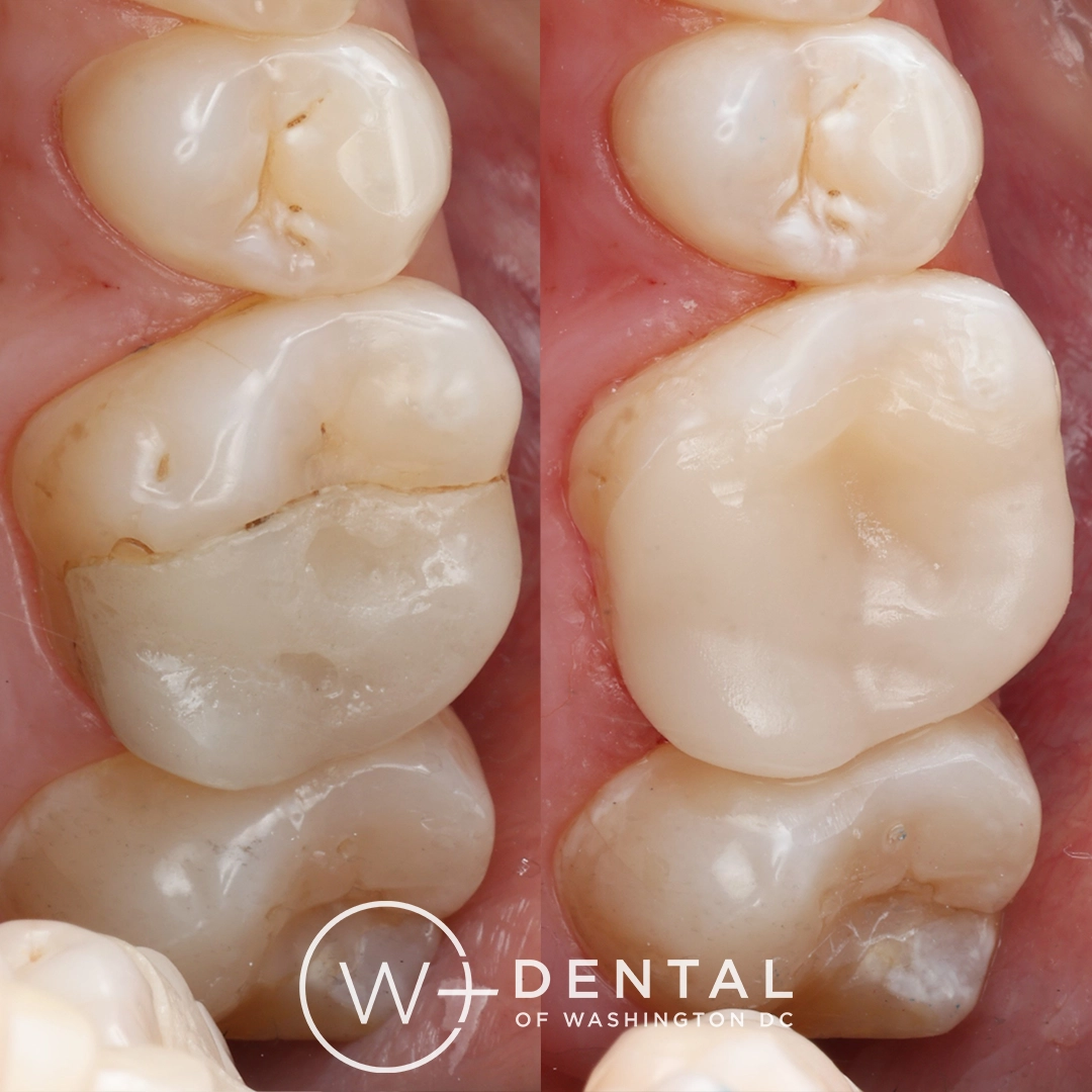 before and after dental bonding for a chipped tooth