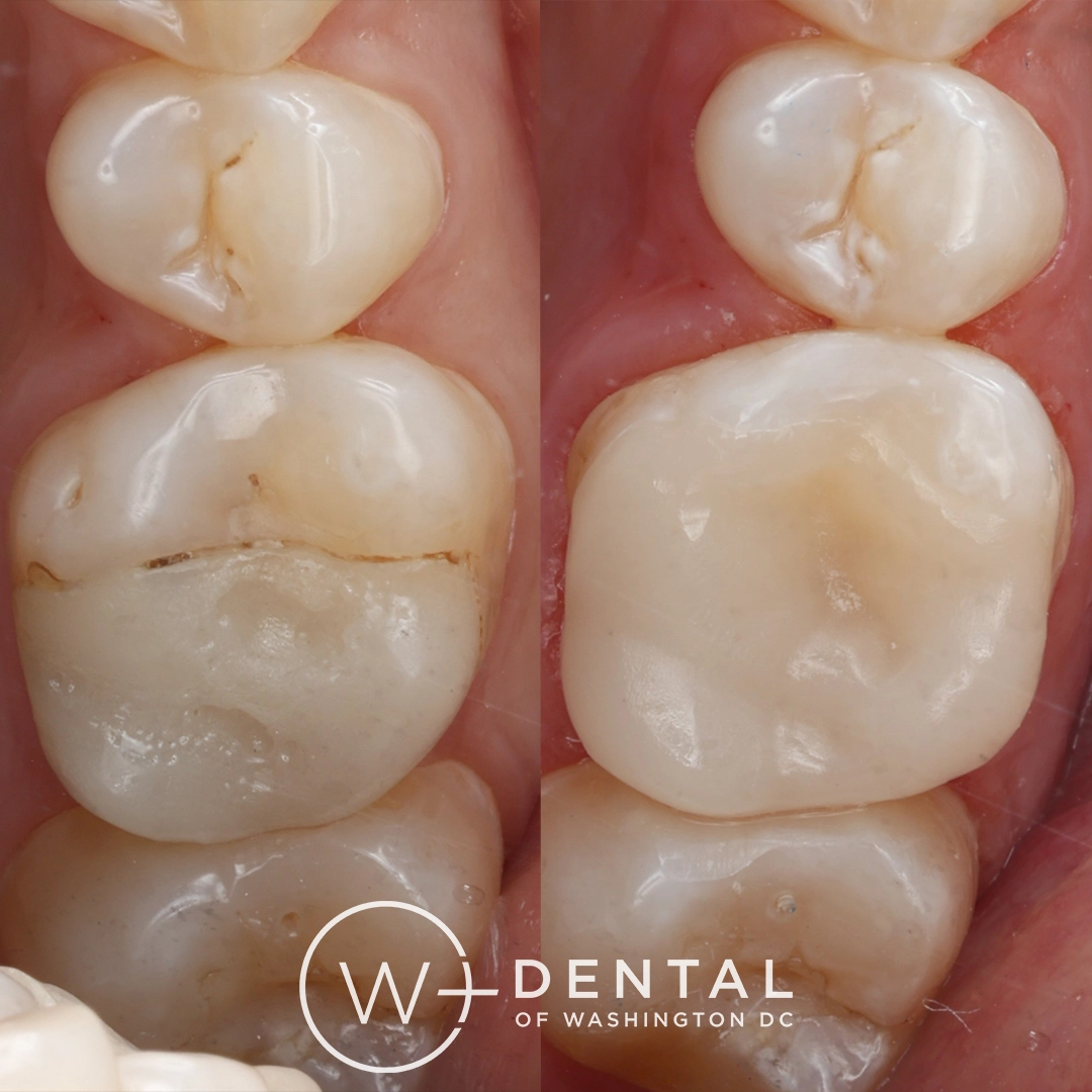 before and after dental bonding for a chipped tooth