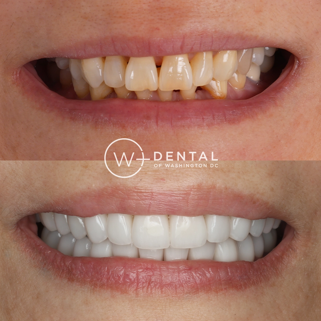 before and after dental bonding for a chipped tooth