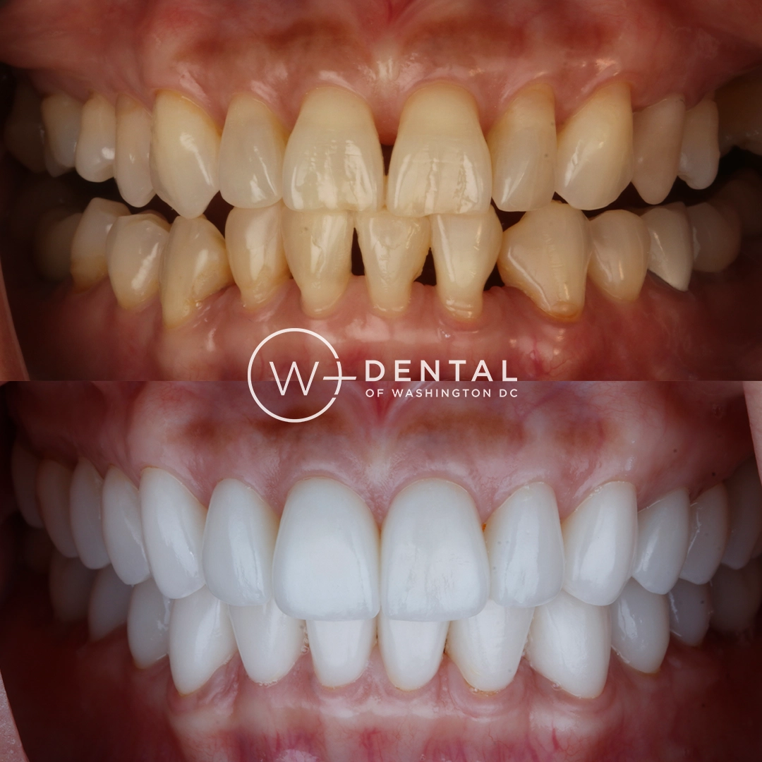 before and after dental bonding for a chipped tooth