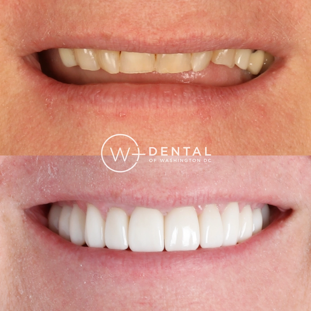 before and after dental bonding for a chipped tooth
