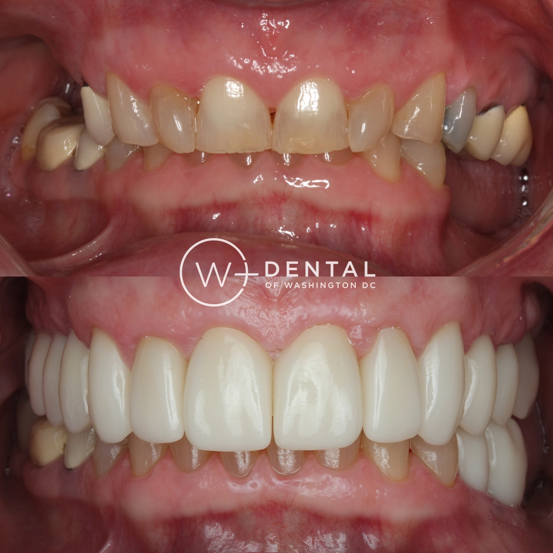 before and after dental bonding for a chipped tooth