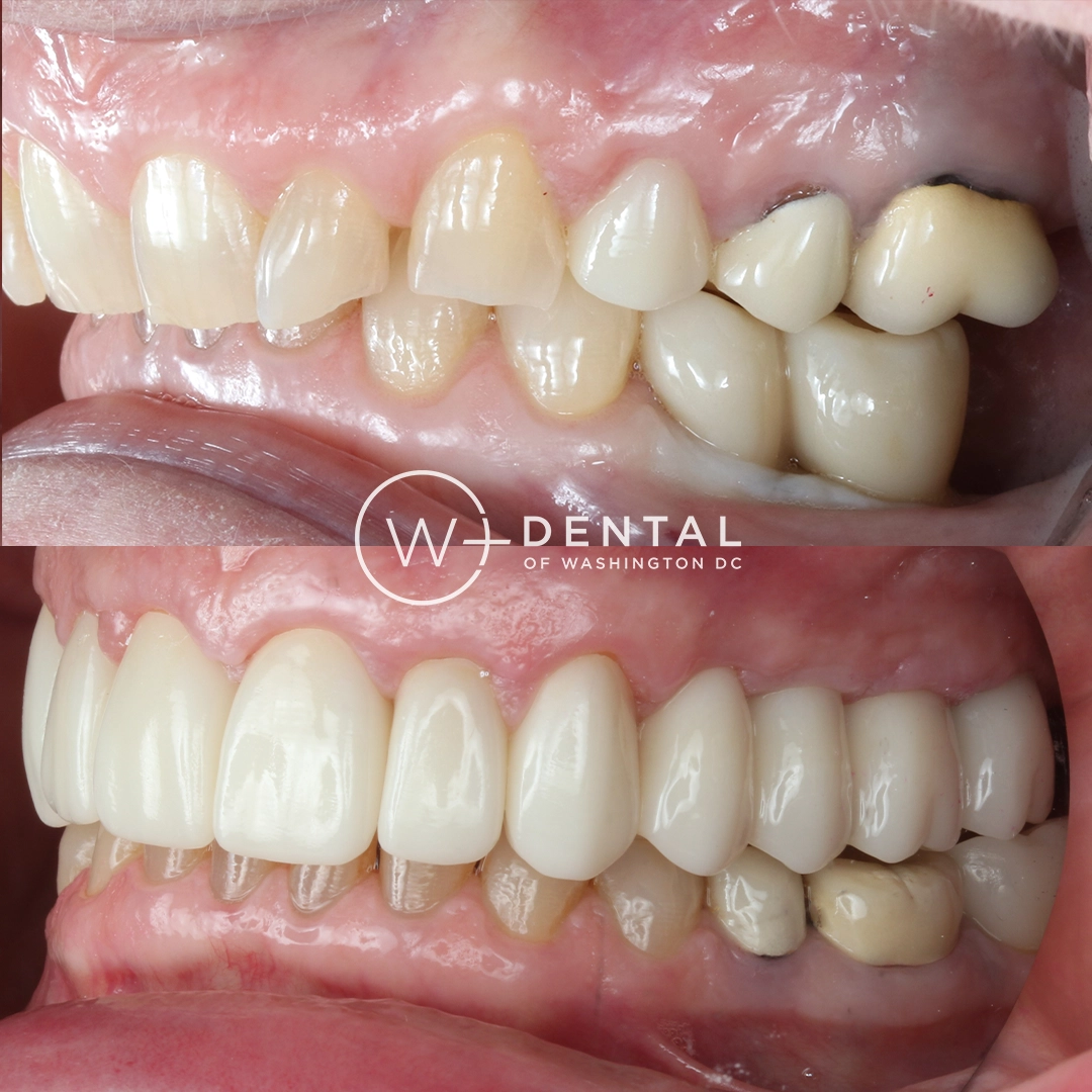 before and after dental bonding for a chipped tooth