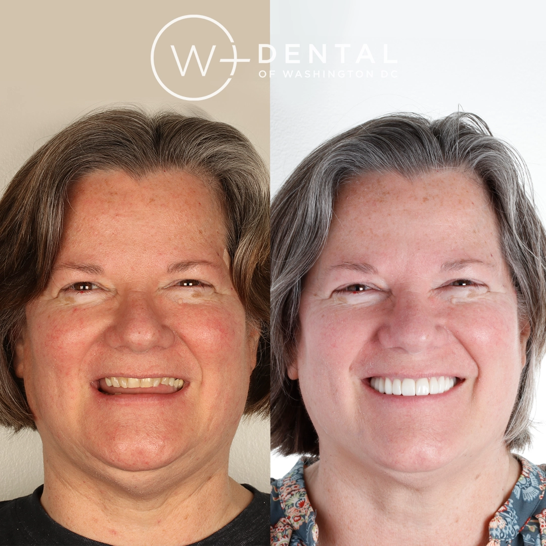 before and after dental bonding for a chipped tooth
