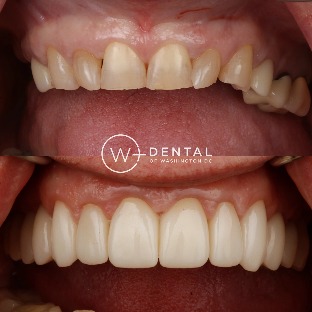 before and after dental bonding for a chipped tooth
