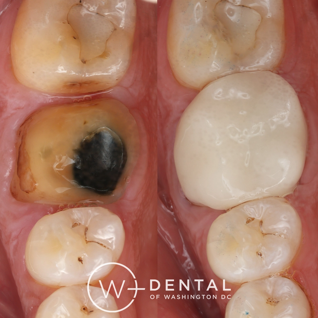 before and after dental bonding for a chipped tooth