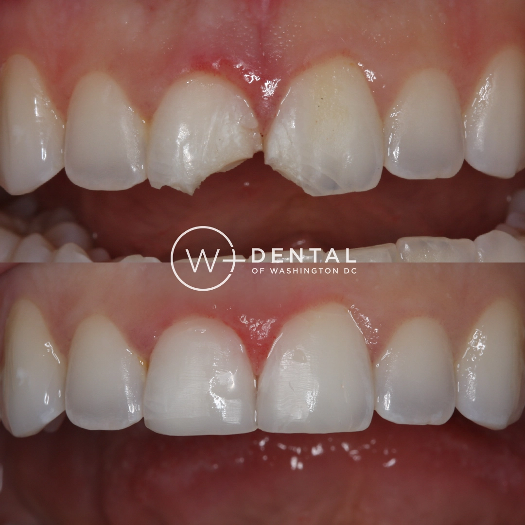 before and after dental bonding for a chipped tooth