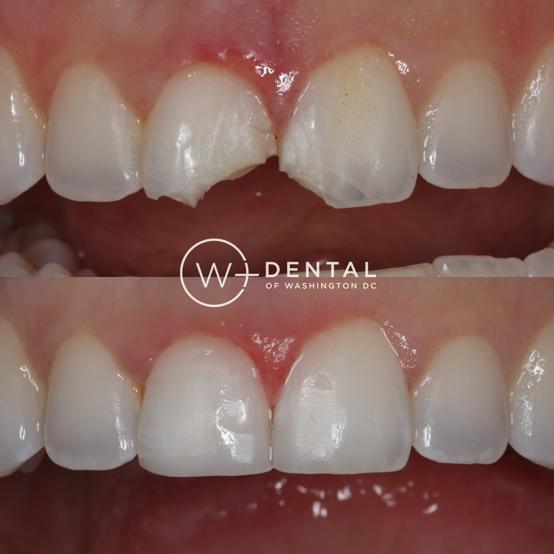 before and after dental bonding for a chipped tooth