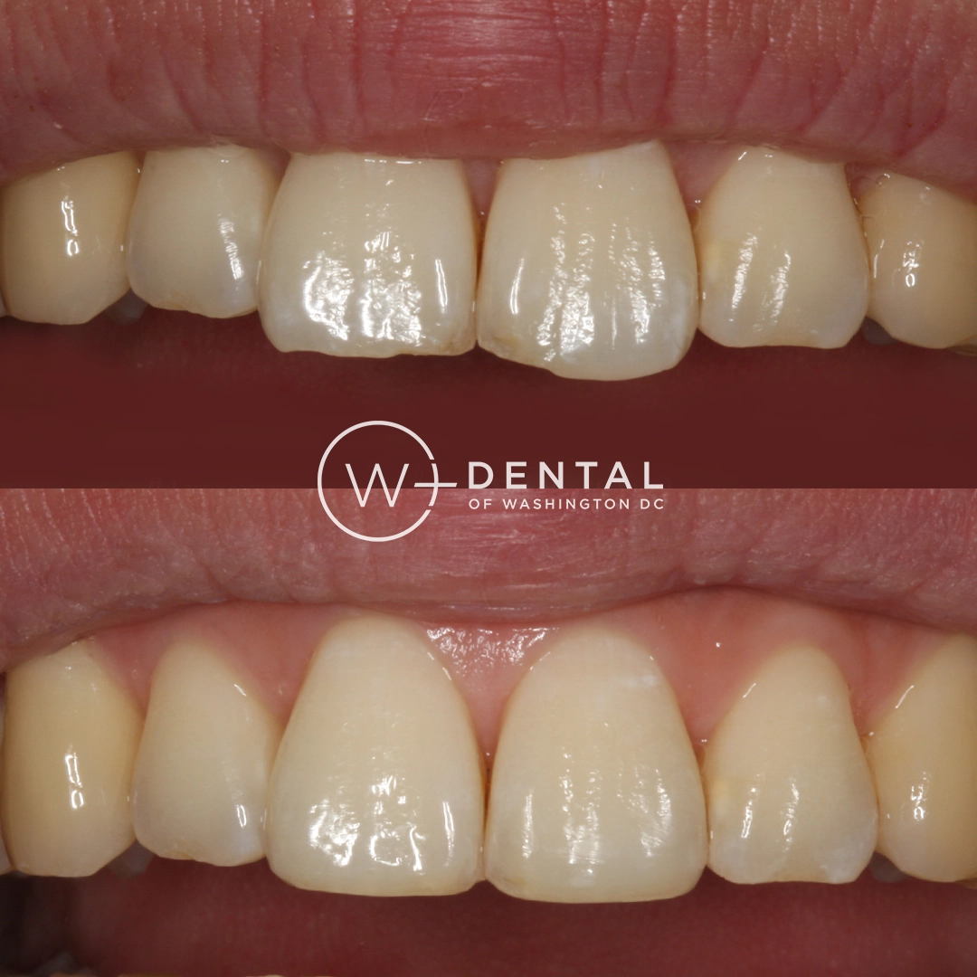 before and after dental bonding for a chipped tooth