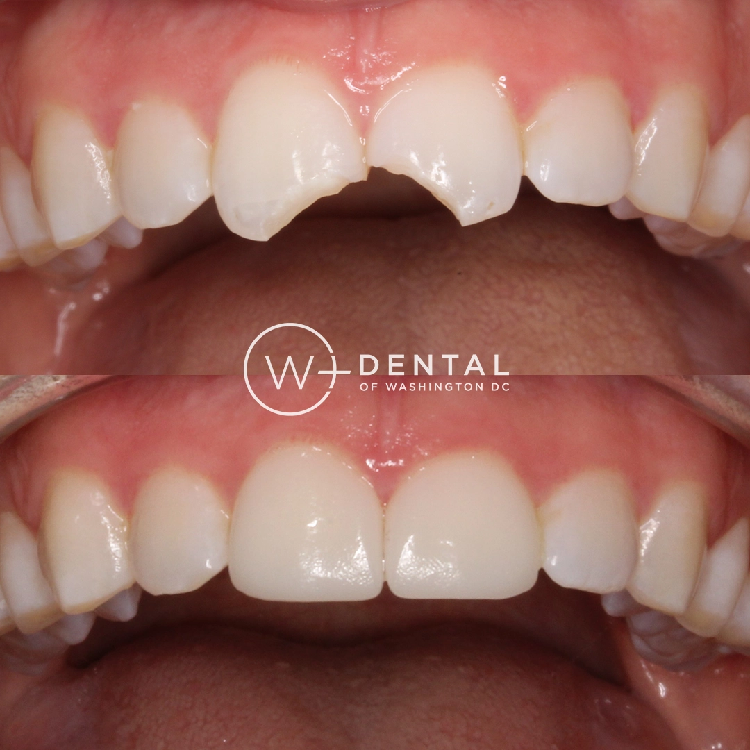 before and after dental bonding for a chipped tooth