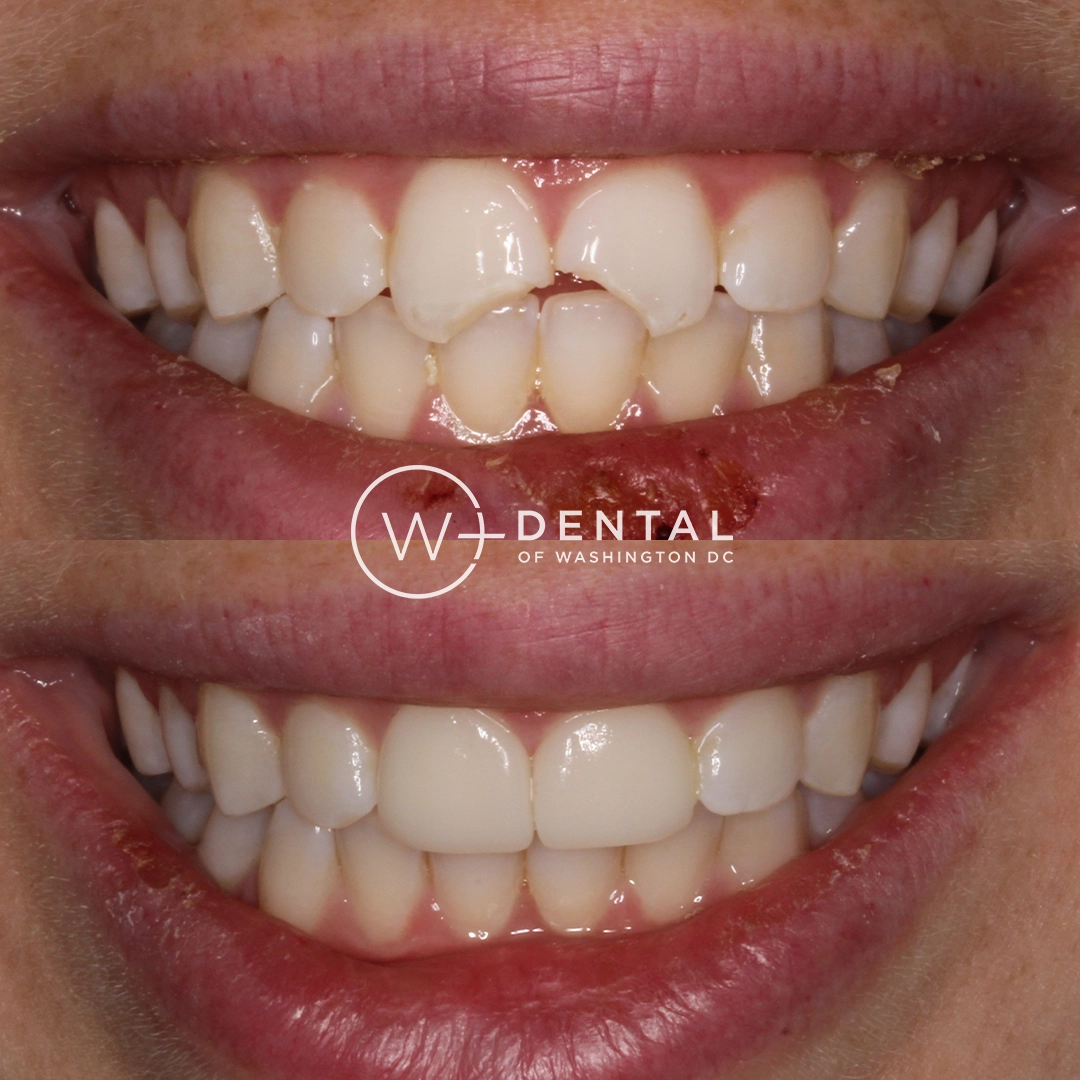 before and after dental bonding for a chipped tooth