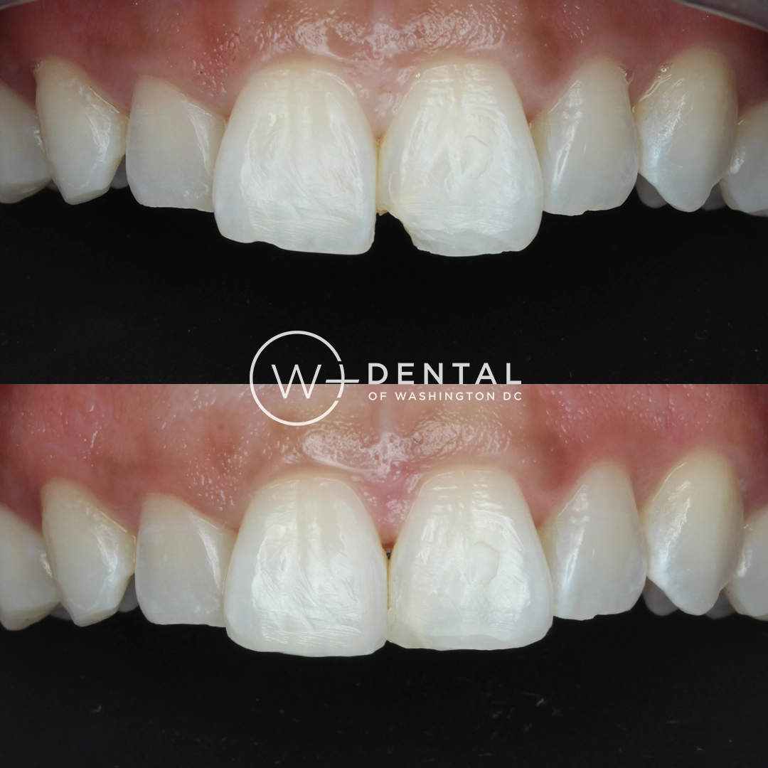 before and after dental bonding for a chipped tooth