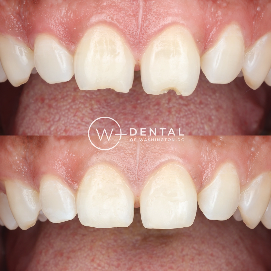before and after dental bonding for a chipped tooth