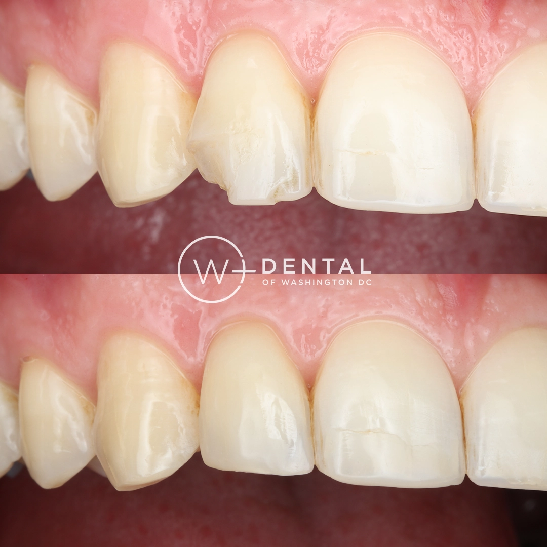before and after dental bonding for a chipped tooth