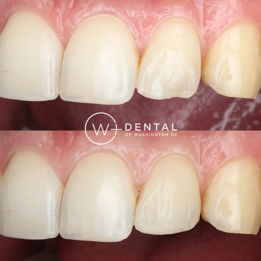 before and after dental bonding for a chipped tooth