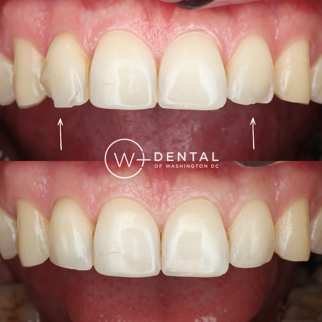 before and after dental bonding for a chipped tooth