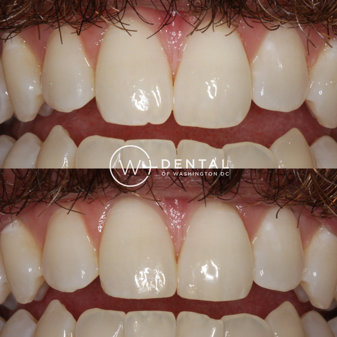 before and after dental bonding for a chipped tooth