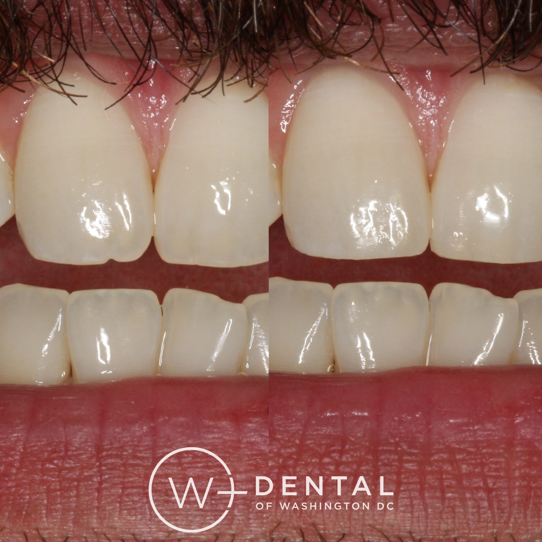 before and after dental bonding for a chipped tooth