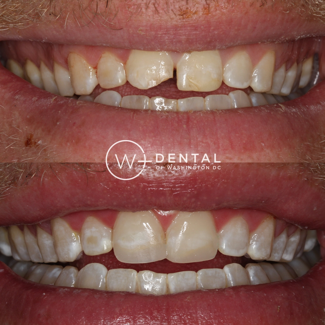 before and after dental bonding for a chipped tooth
