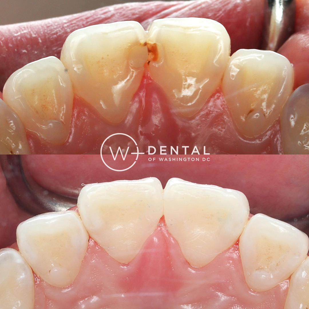 before and after dental bonding for a chipped tooth