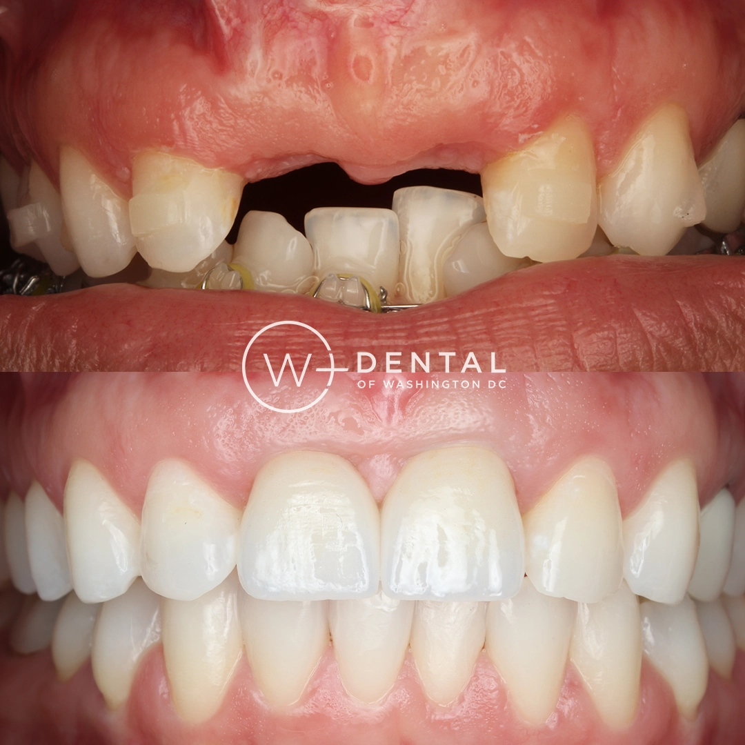 before and after dental bonding for a chipped tooth