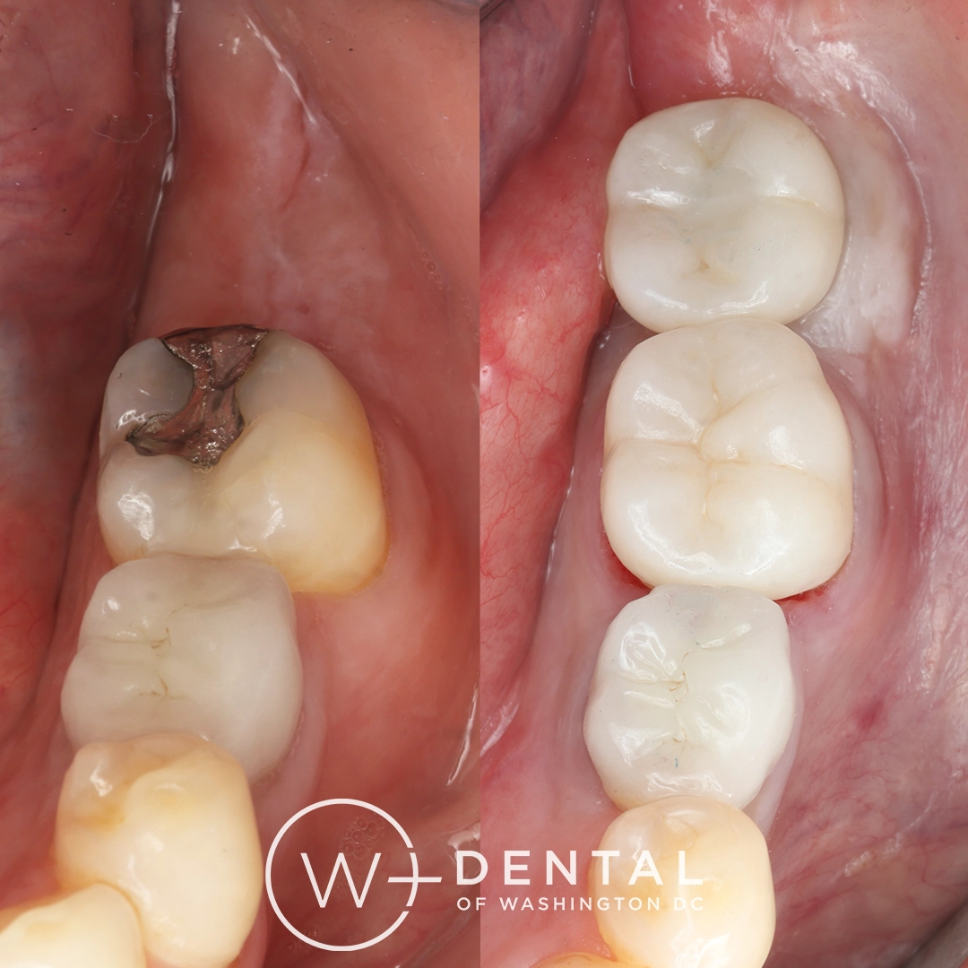 before and after dental bonding for a chipped tooth